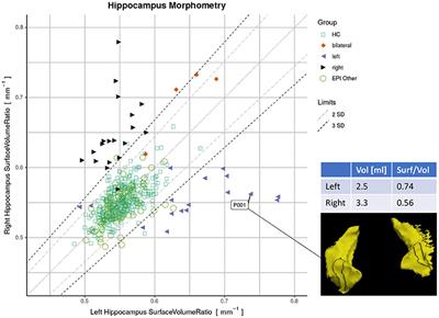 A Quantitative Imaging Biomarker Supporting Radiological Assessment of Hippocampal Sclerosis Derived From Deep Learning-Based Segmentation of T1w-MRI